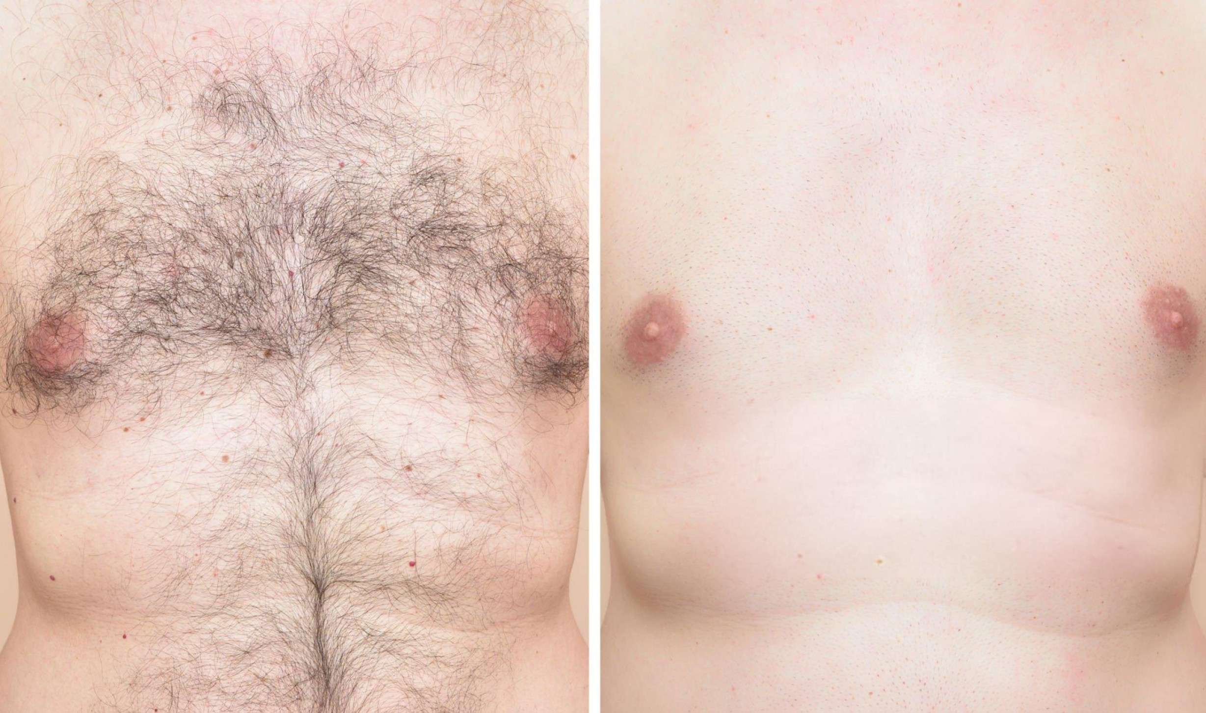 Quad Laser Hair Removal