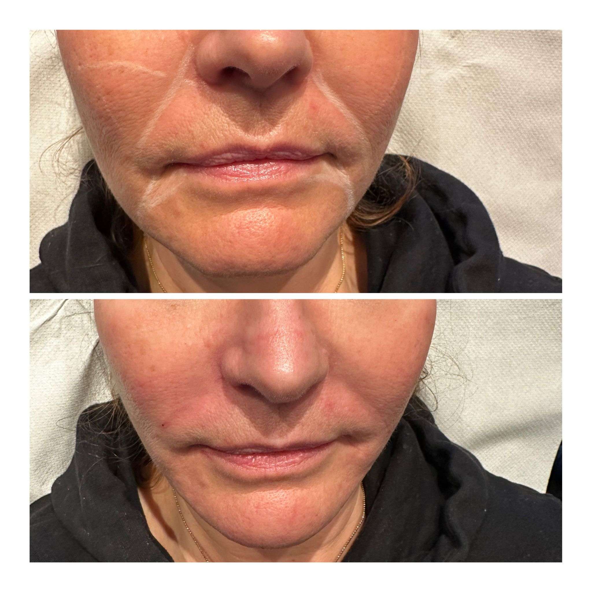 Hair Removal Treatment