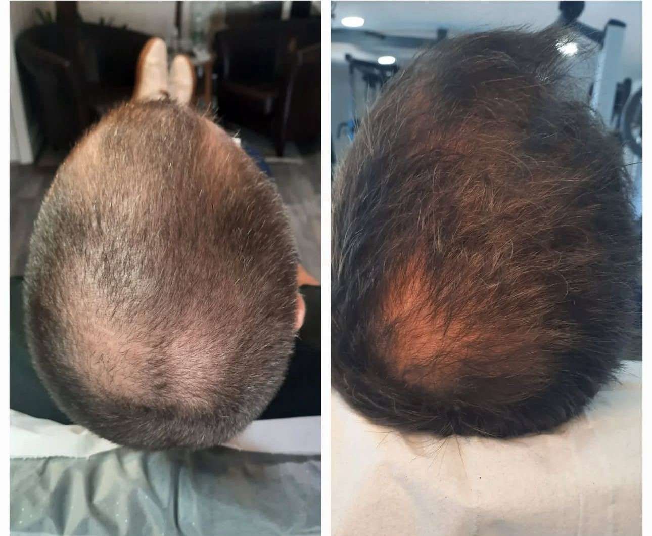 PRP Hair Restoration